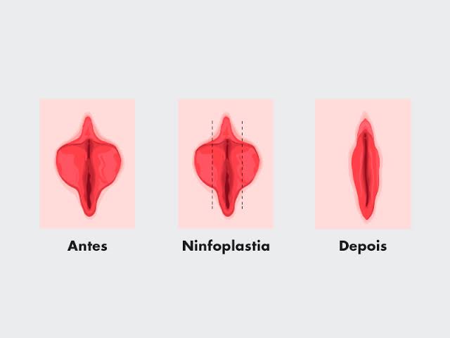 ninfoplastia